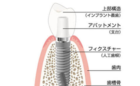 インプラント治療